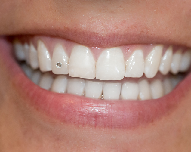 Parodontosebehandlung