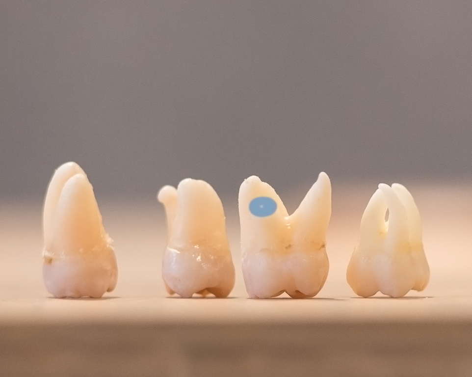 Wurzelspitzenresektion